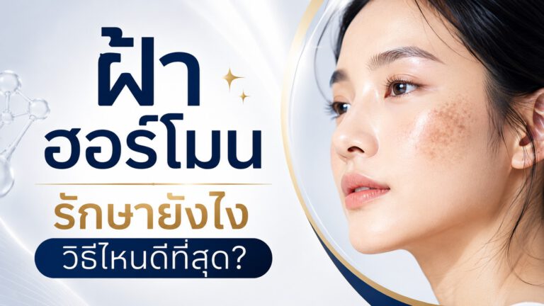ฝ้าฮอร์โมนรักษายังไง วิธีไหนดีที่สุด?